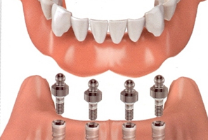 Implantes